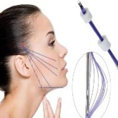 Fio filler