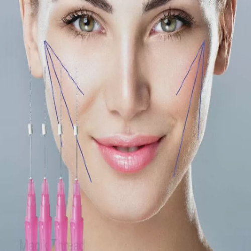 Fio liso para estimulação de colágeno