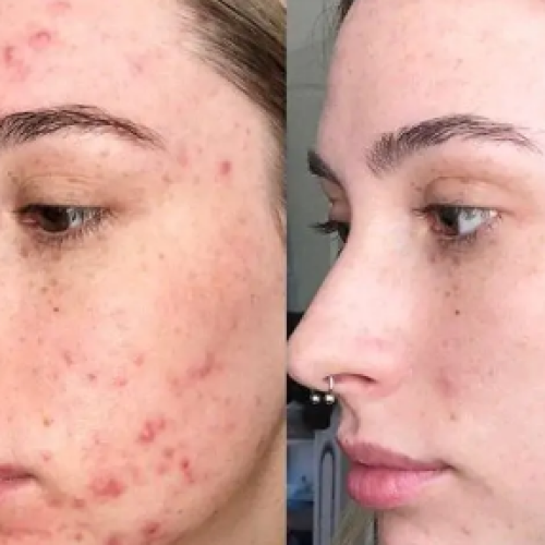 Peeling para Cicatrizes de acne