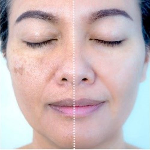 Peeling para Clareador de manchas e melasma