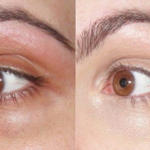 Peeling para Clareamento de olheira