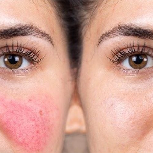 Peeling para Rosácea