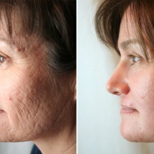 Peeling para rejuvenescimento