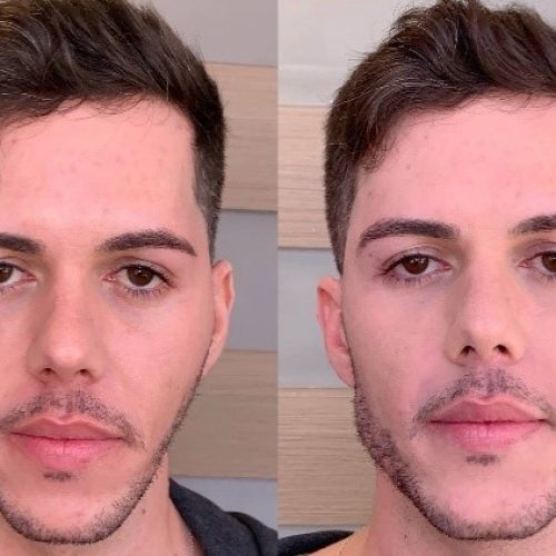 Preenchedores faciais com ácido hialurônico